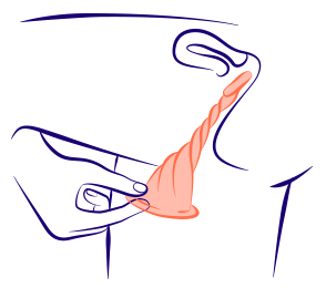 Préservatif interne torsadé et tiré vers l'extérieur du vagin